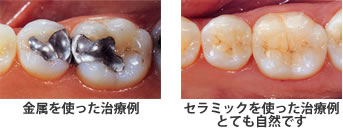 セラミック治療